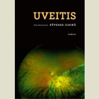 Uveitis